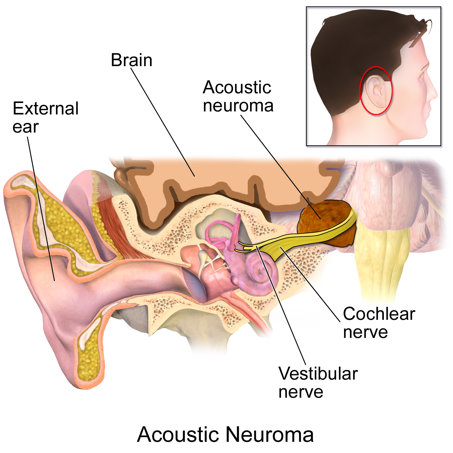 Top Causes of Tinnitus Best Tinnitus Treatment NYC